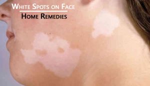 White Patches on Face and Home Remedies to Treat It