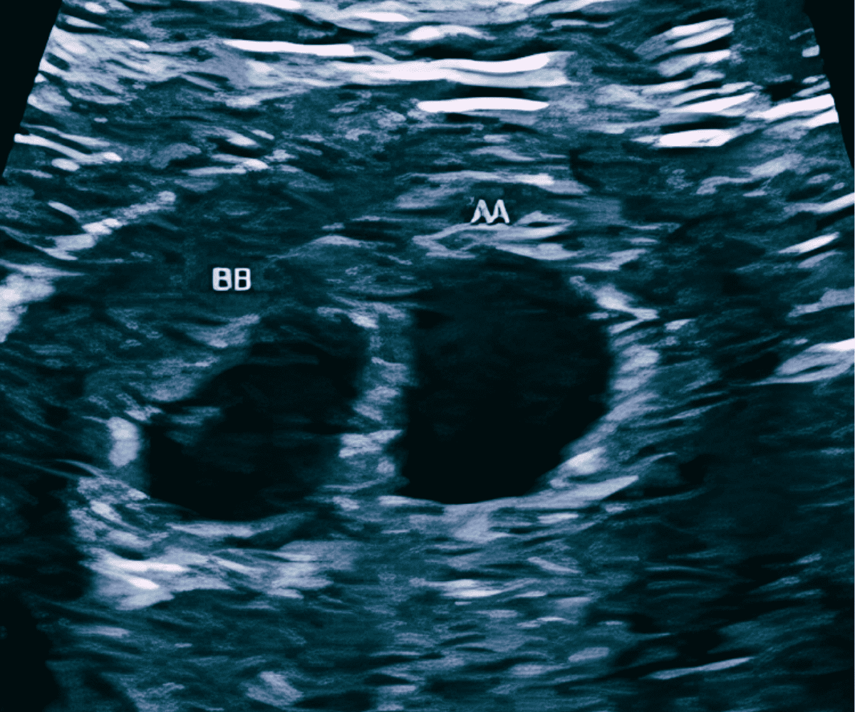 6 weeks pregnant ultrasound with twins