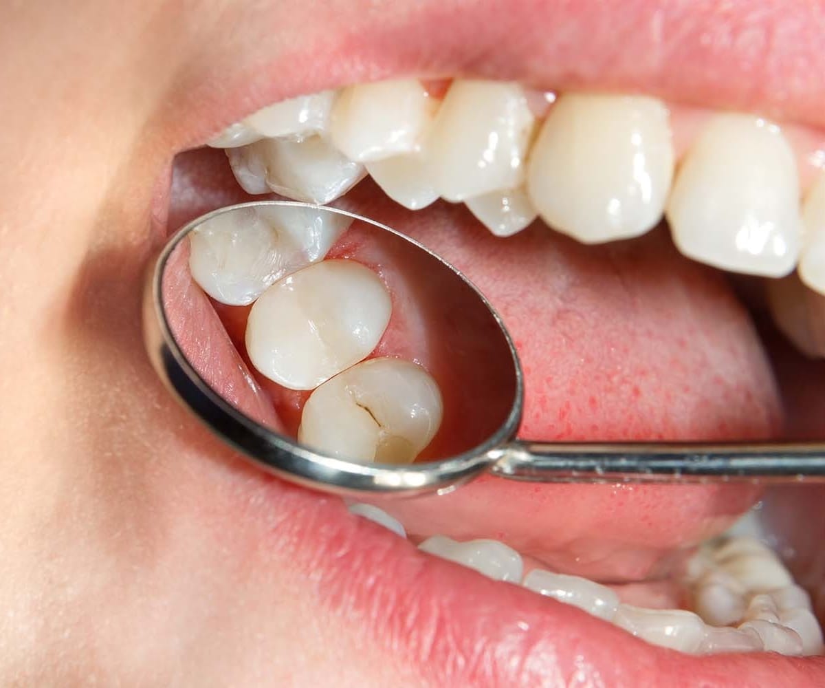 Composite Filling