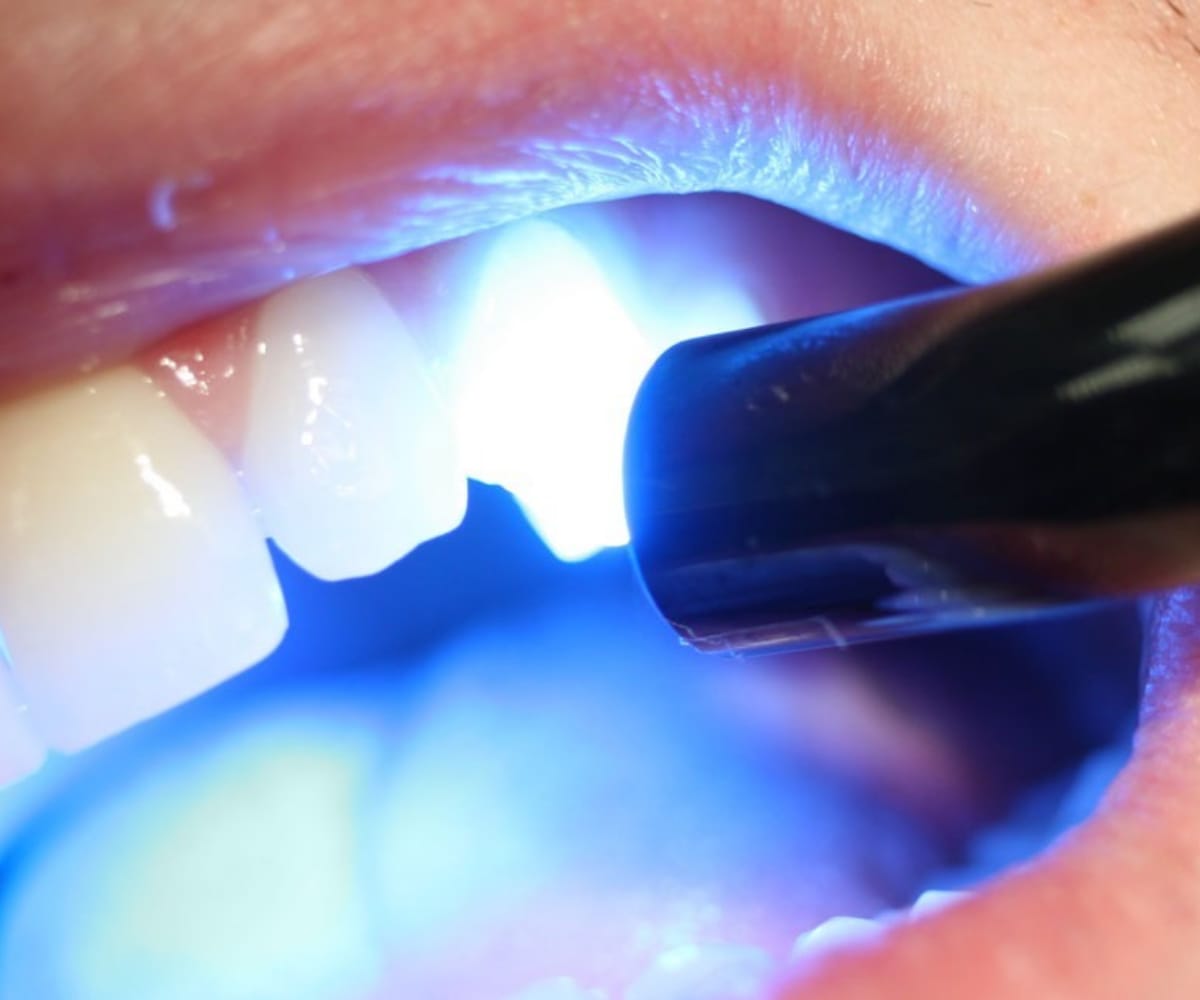 Composite Filling