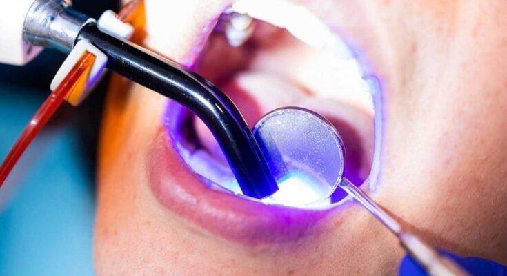 Composite Filling : The Ultimate Guide to Tooth-Colored Dental Restorations
