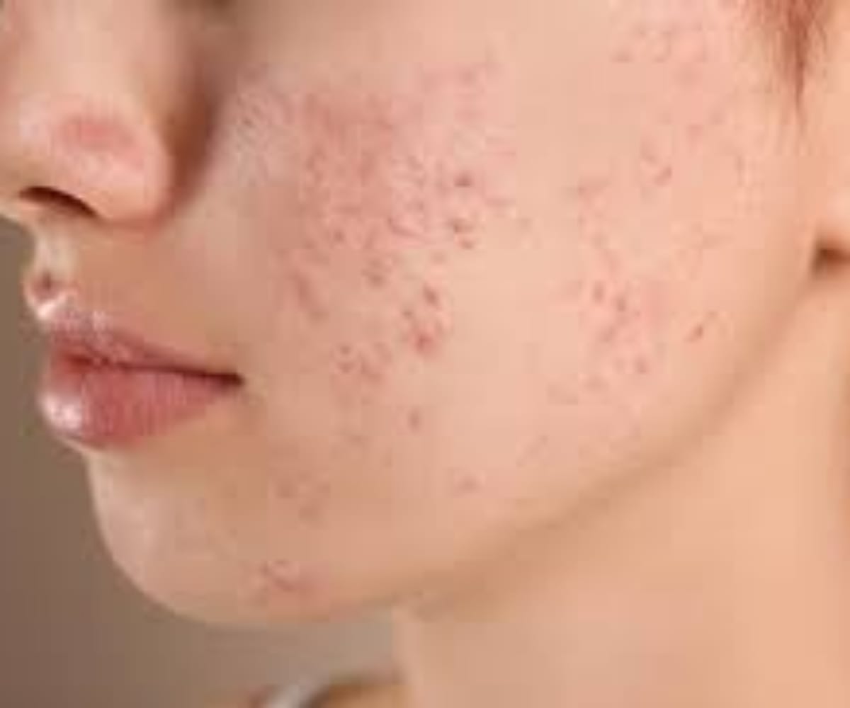 Acne Treatment