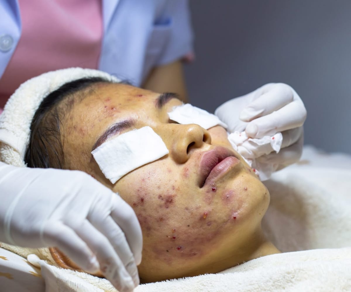 Acne Treatment