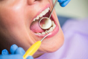 Tooth Filling