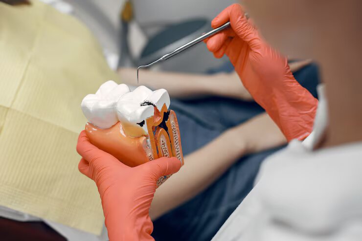 Tooth Filling