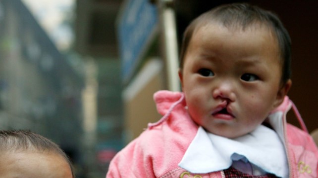 cleft-lip