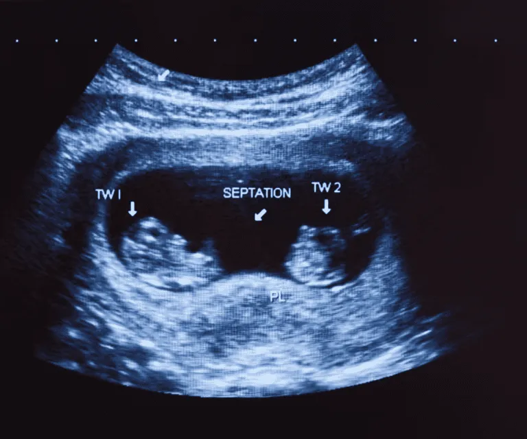6 Weeks Pregnant Ultrasound with Twins: A Comprehensive Guide